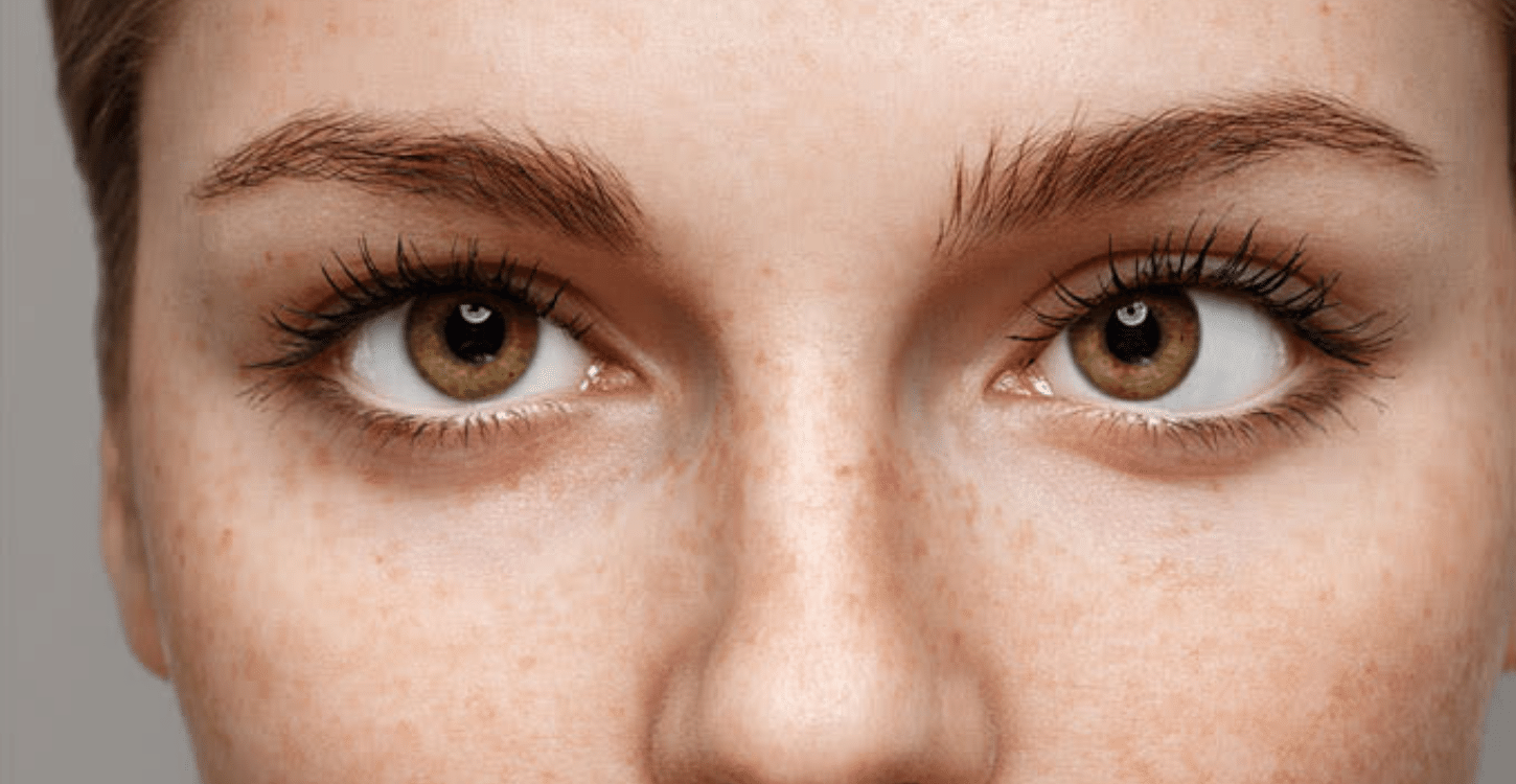 Olhos alinhados, resultado esperado após cirurgia de estrabismo.