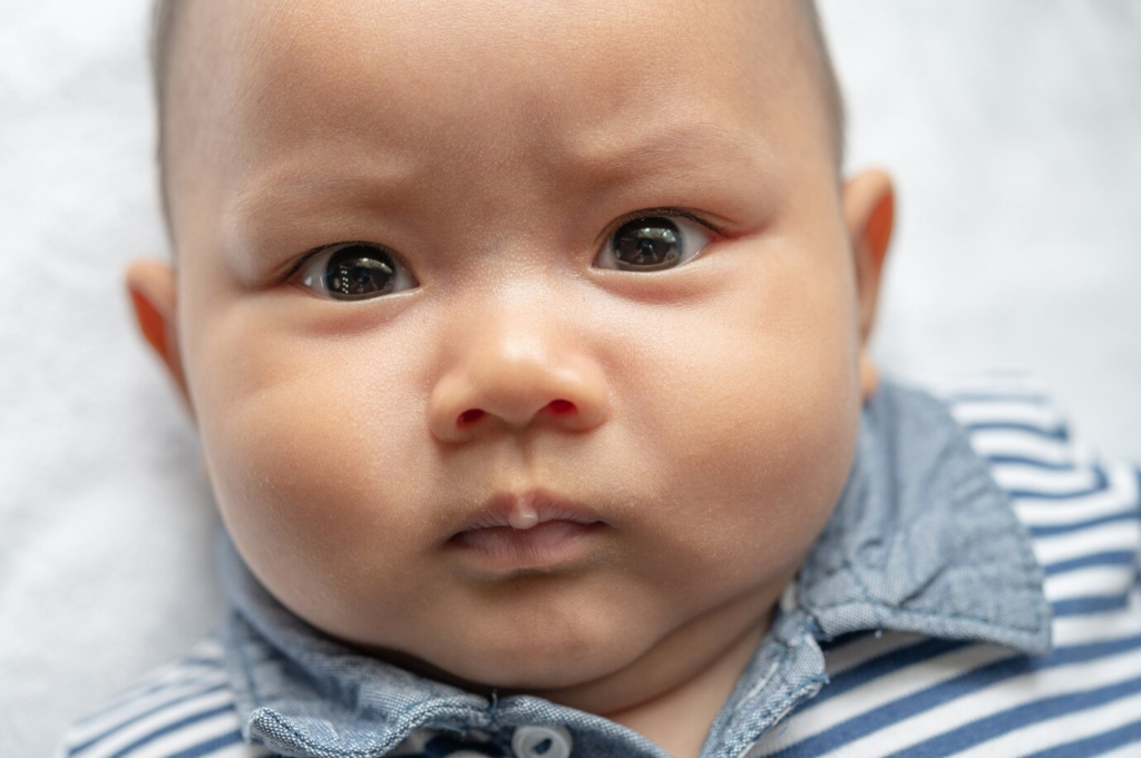 Rosto de um bebê com expressão séria e olhos desalinhados. Palavras-chave: Estrabismo em bebê.