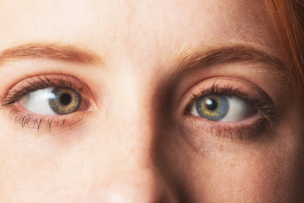 Close-up de olhos desalinhados, condição corrigida por cirurgia de estrabismo.