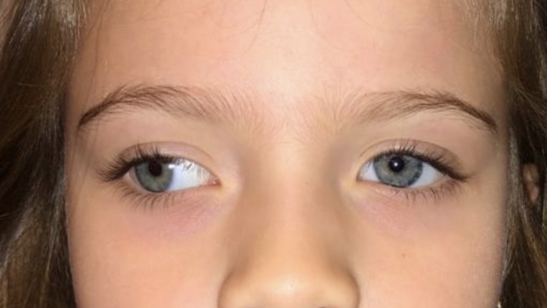 estrabismo divergente