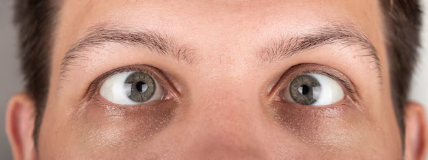 Homem com olhos ligeiramente desalinhados olhando para cima.
