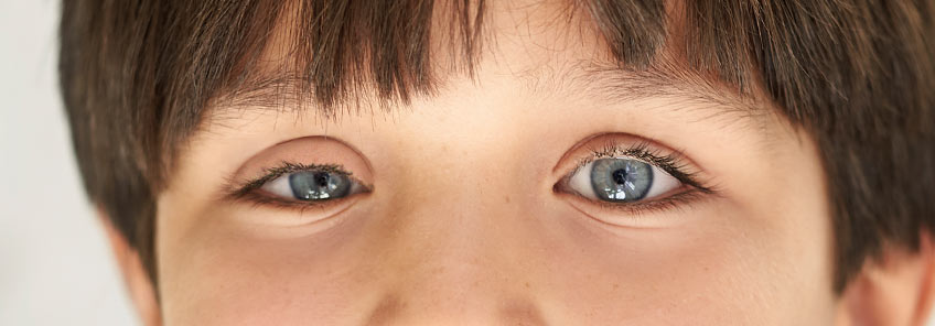 Ptose palpebral